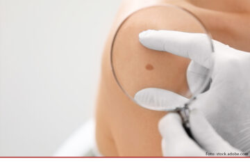Steigende Hautkrebsdiagnosen